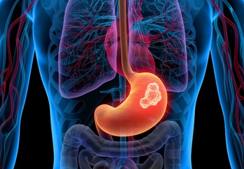 Ung thư dạ dày có thể chữa khỏi hoàn toàn không